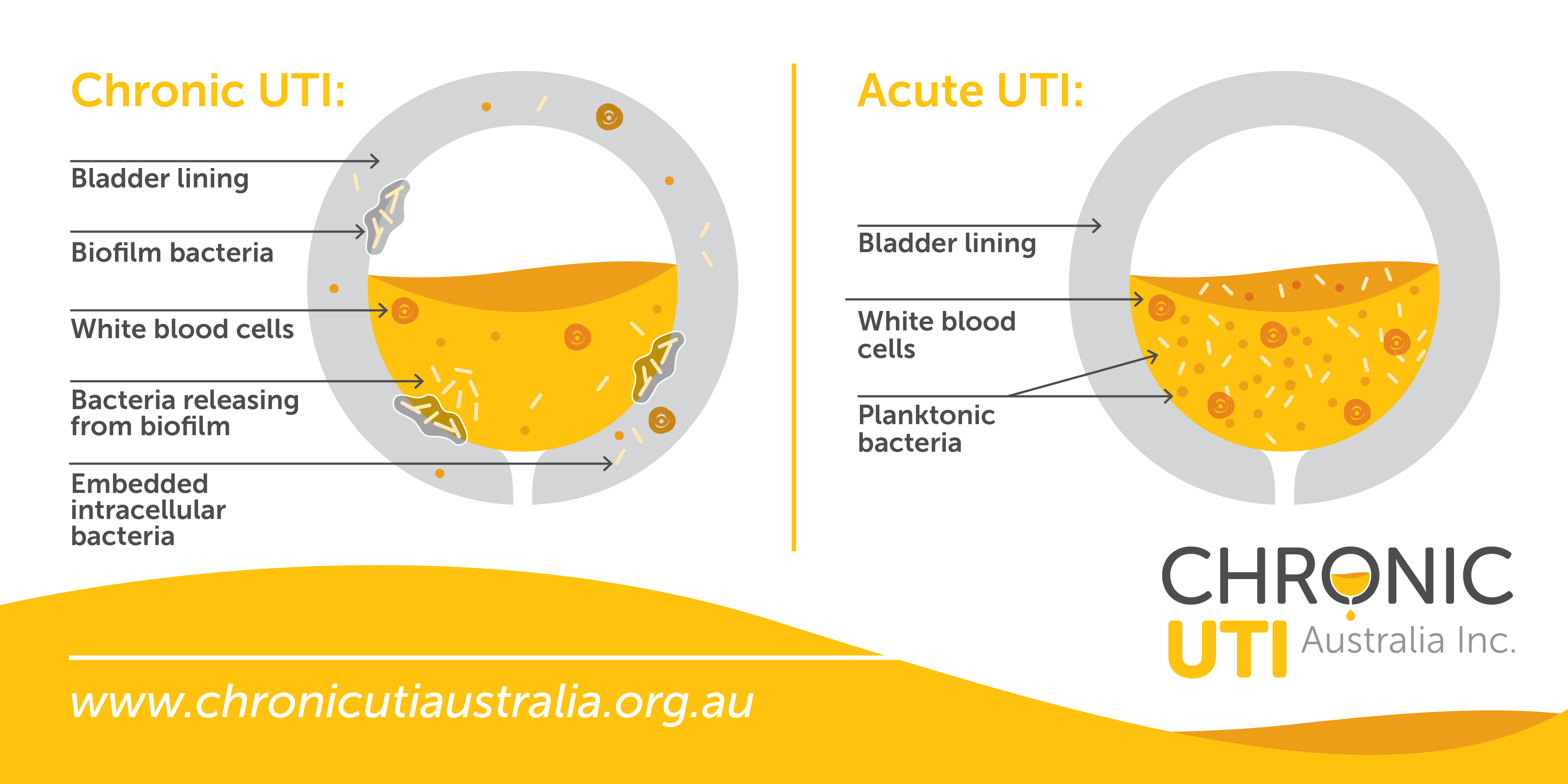 Acute UTI Chronic UTI Chronic UTI Australia